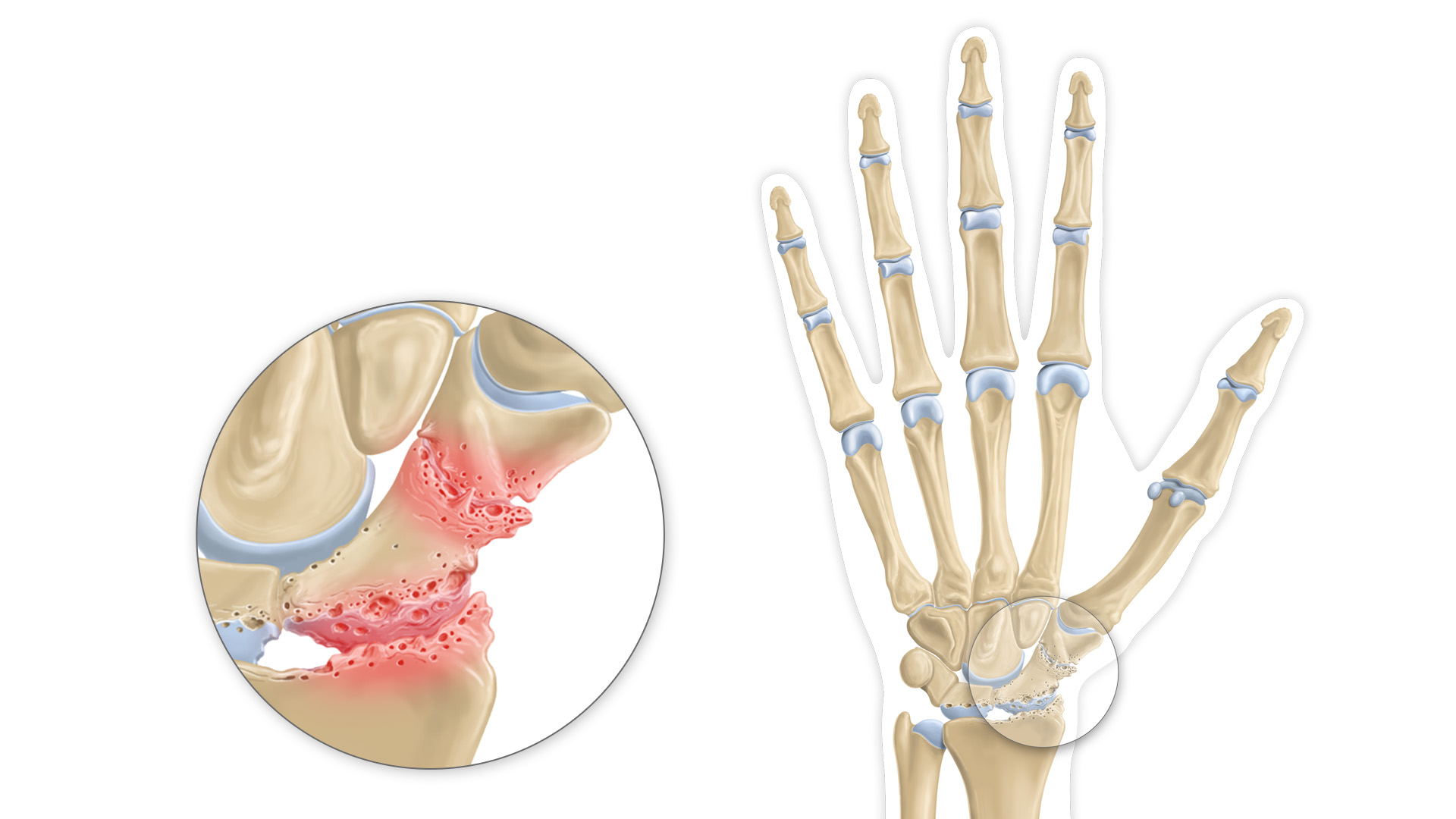 Arthrose du poignet à Bordeaux  Chirurgie de la main & du poignet